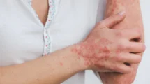 Psoriasis